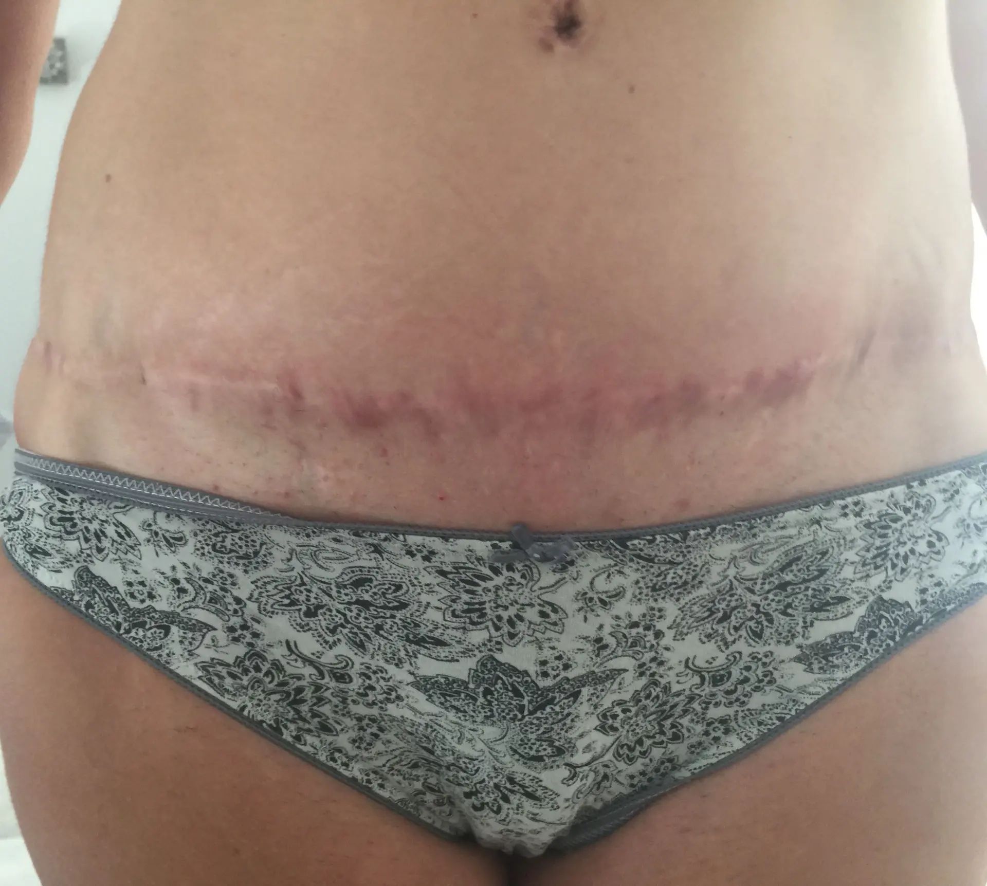 Abdominoplastie Et Liposuccion Du Ventre Et Des Hanches Estheticon Fr