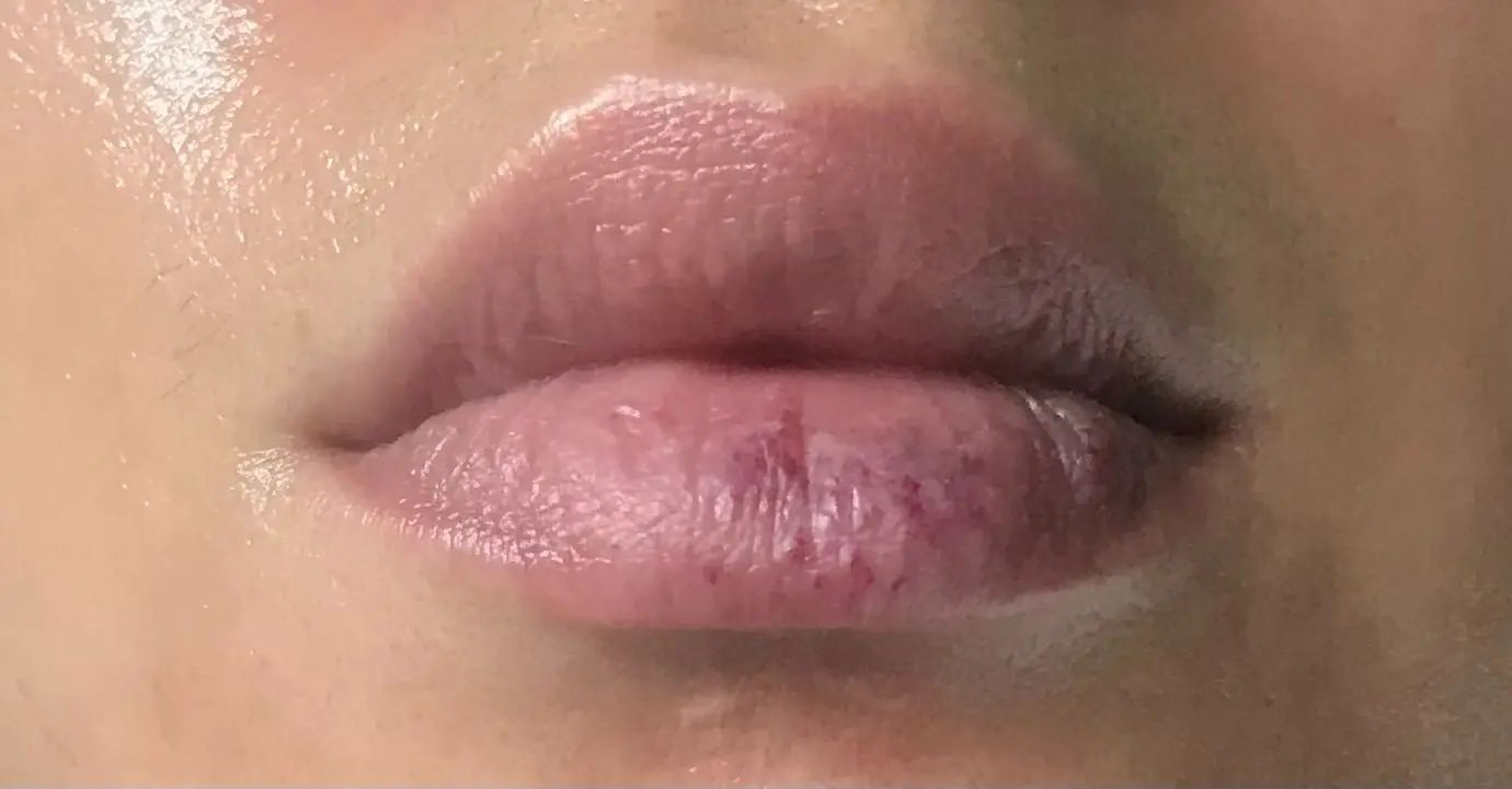 Taches rouges sur lèvre inférieure?? | Estheticon.fr