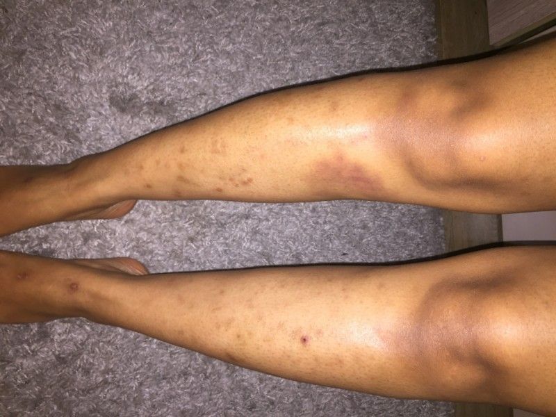 Traitement des cicatrices sur les jambes - Traitement des ...