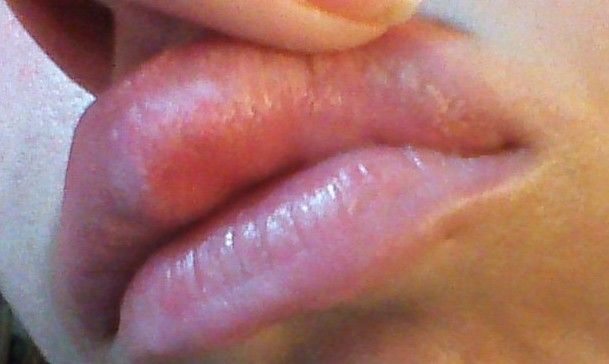 Augmentation des lèvres : je pense faire une allergie ...