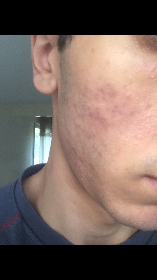 Que faire contre ces Cicatrices d acné ? - Traitement de l'acné ...