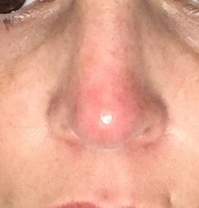 Nez rouge après acide hyaluronique | Estheticon.fr