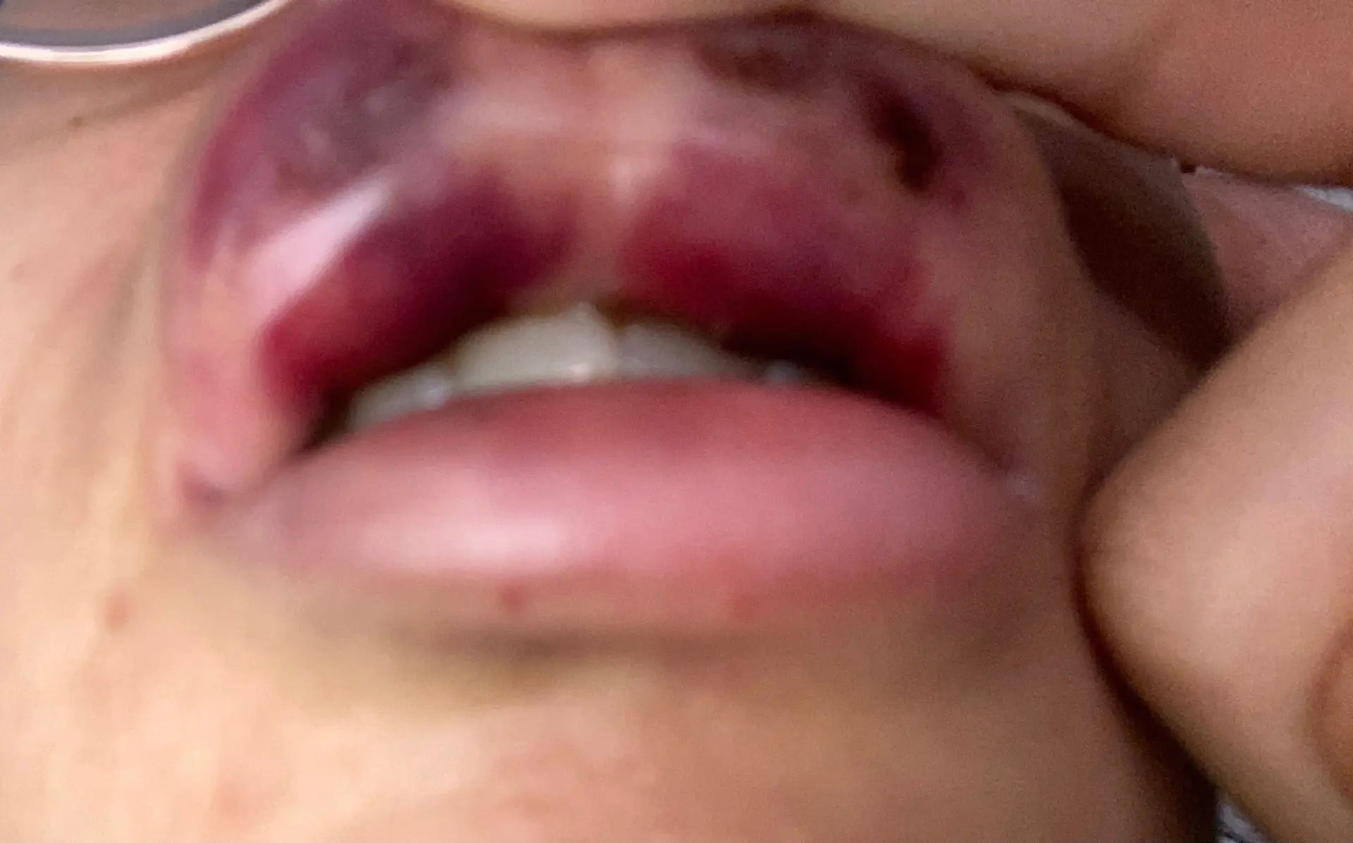 Lèvre supérieure gonflée et des bleus après injections d'acide ...