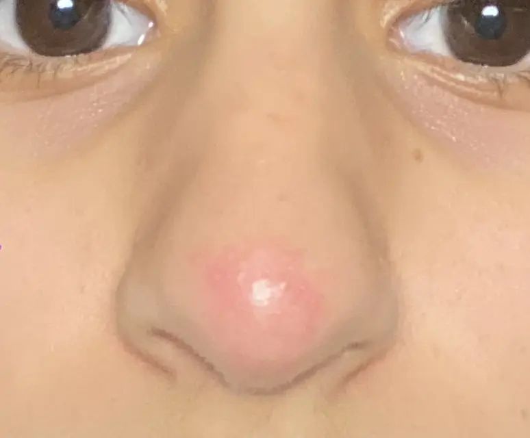 Nez rouge et des boutons après un mois de rhinoplastie médicale ...