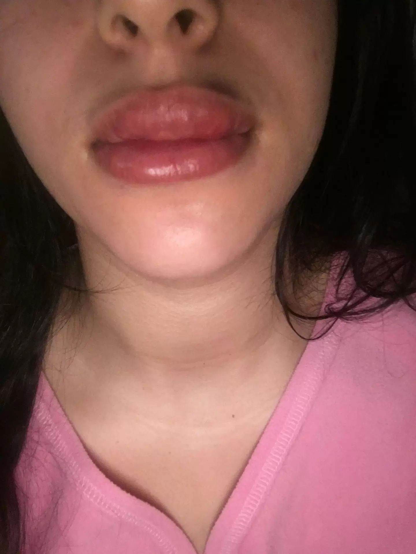 Lèvres trop gonflés après injecter de l'acide hyaluronique , avis ...