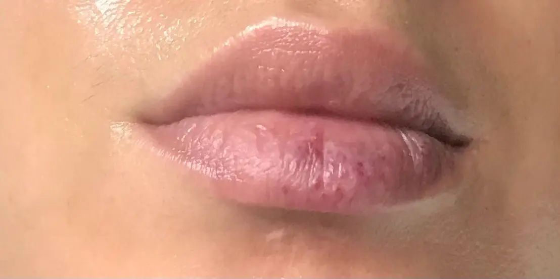 Taches rouges sur lèvre inférieure?? | Estheticon.fr