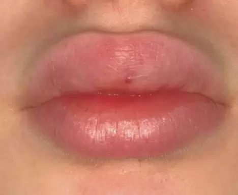 Lèvres trop gonflées suite aux injections d'AH , il est possible ...