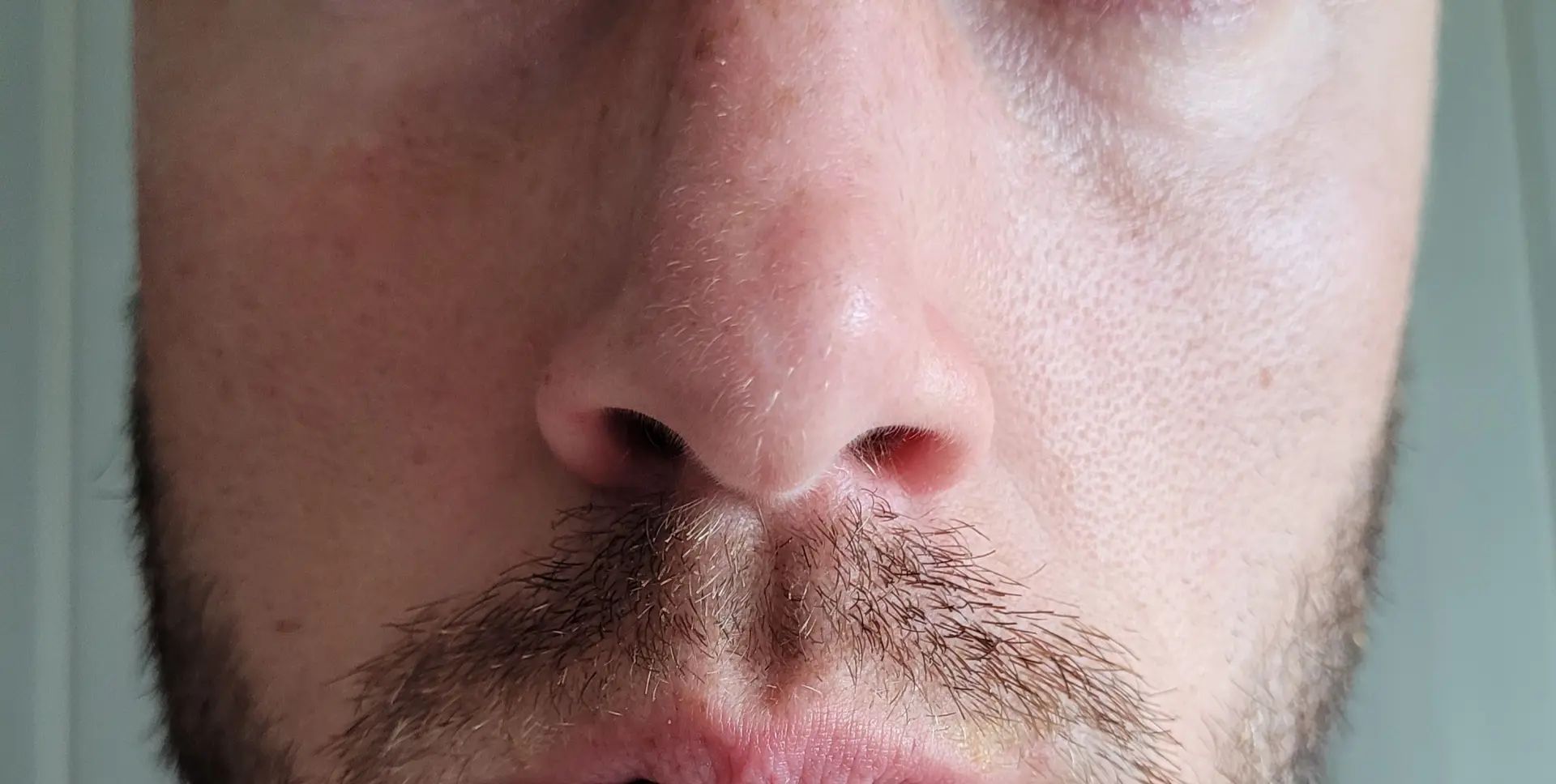 Pointe du nez gonflé d'un côté - Rhinoplastie (chirurgie du nez ...