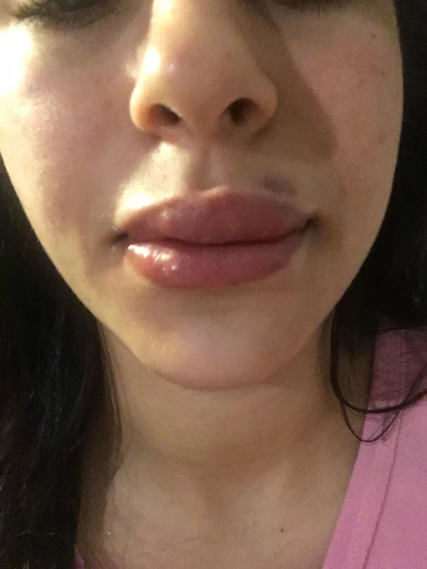 Lèvres trop gonflés après injecter de l'acide hyaluronique , avis ...