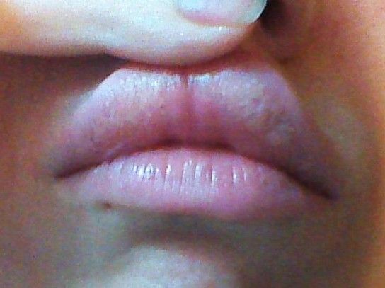 Augmentation des lèvres : je pense faire une allergie ...