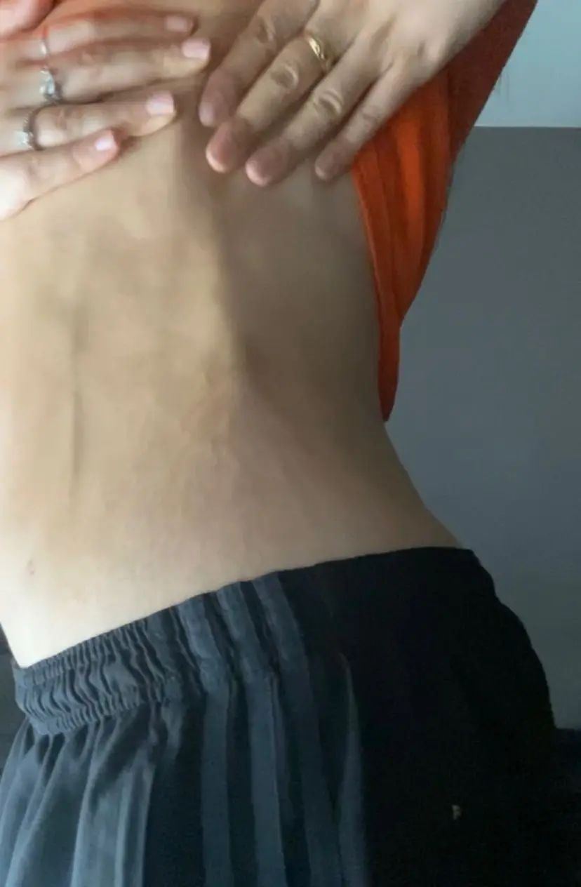 Grosses « veines » sur le ventre après liposuccion | Estheticon.fr