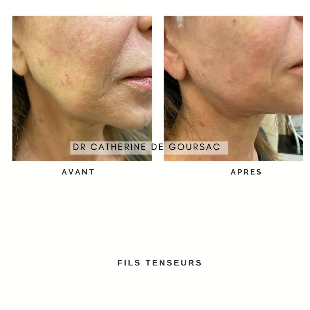 filstenseurscatherine