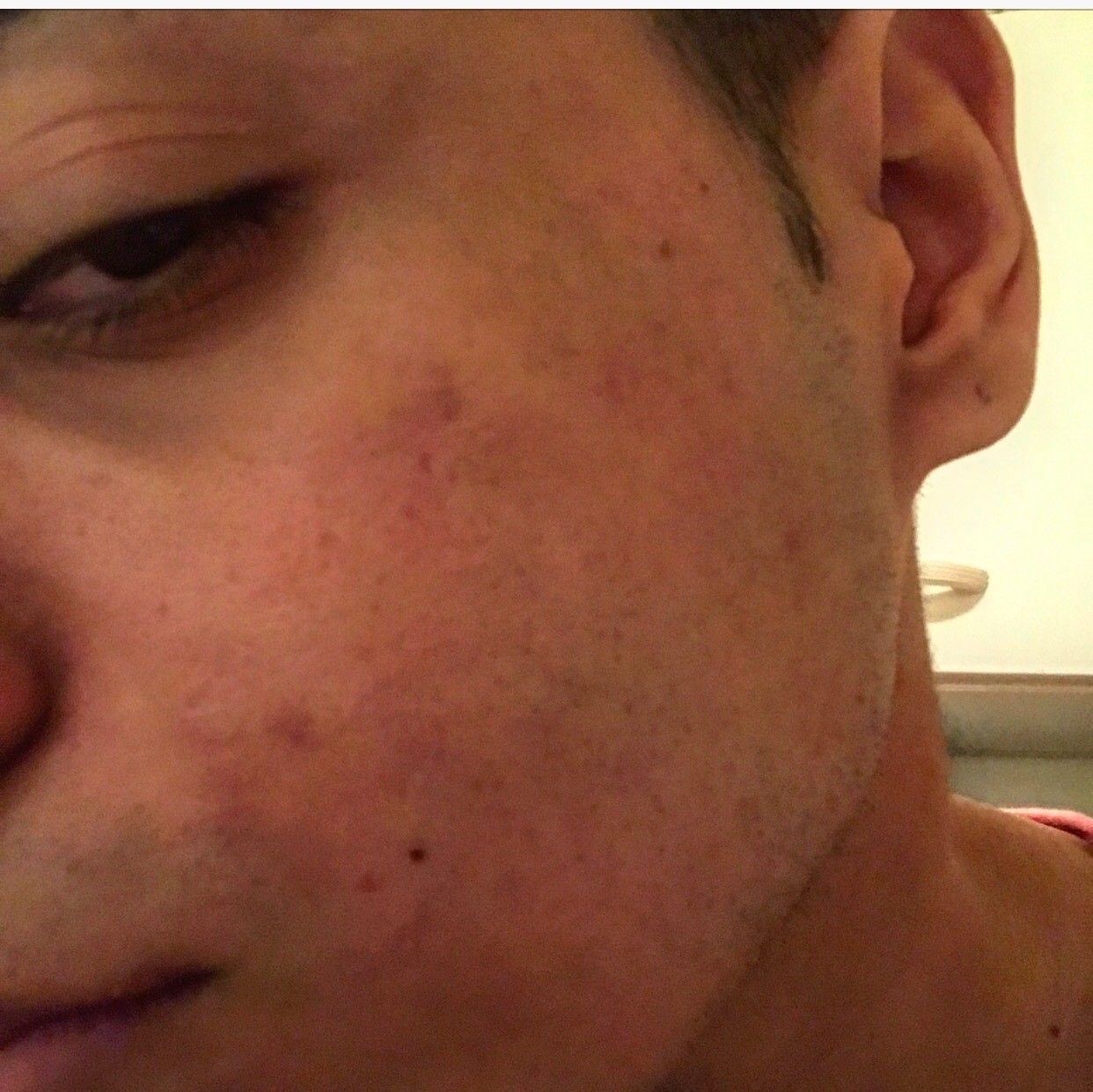 Complexé par mes cicatrices et tâches d'acné | Estheticon.fr