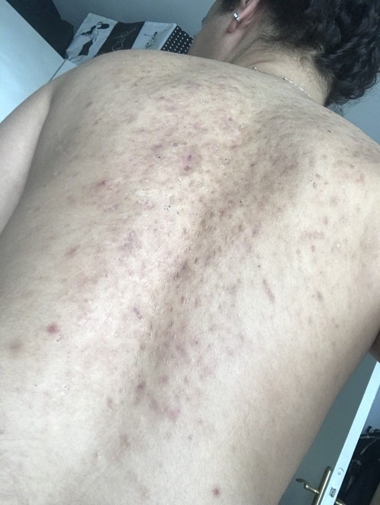 Acnés/ cicatrices dos - Traitements laser - dermatologie ...