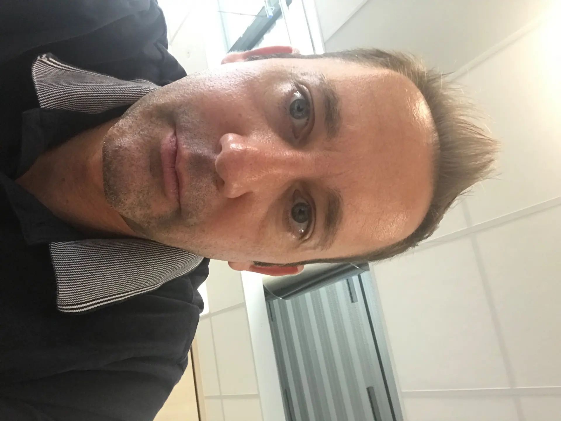 Des séquelles de brûlure et des taches après épilation laser que