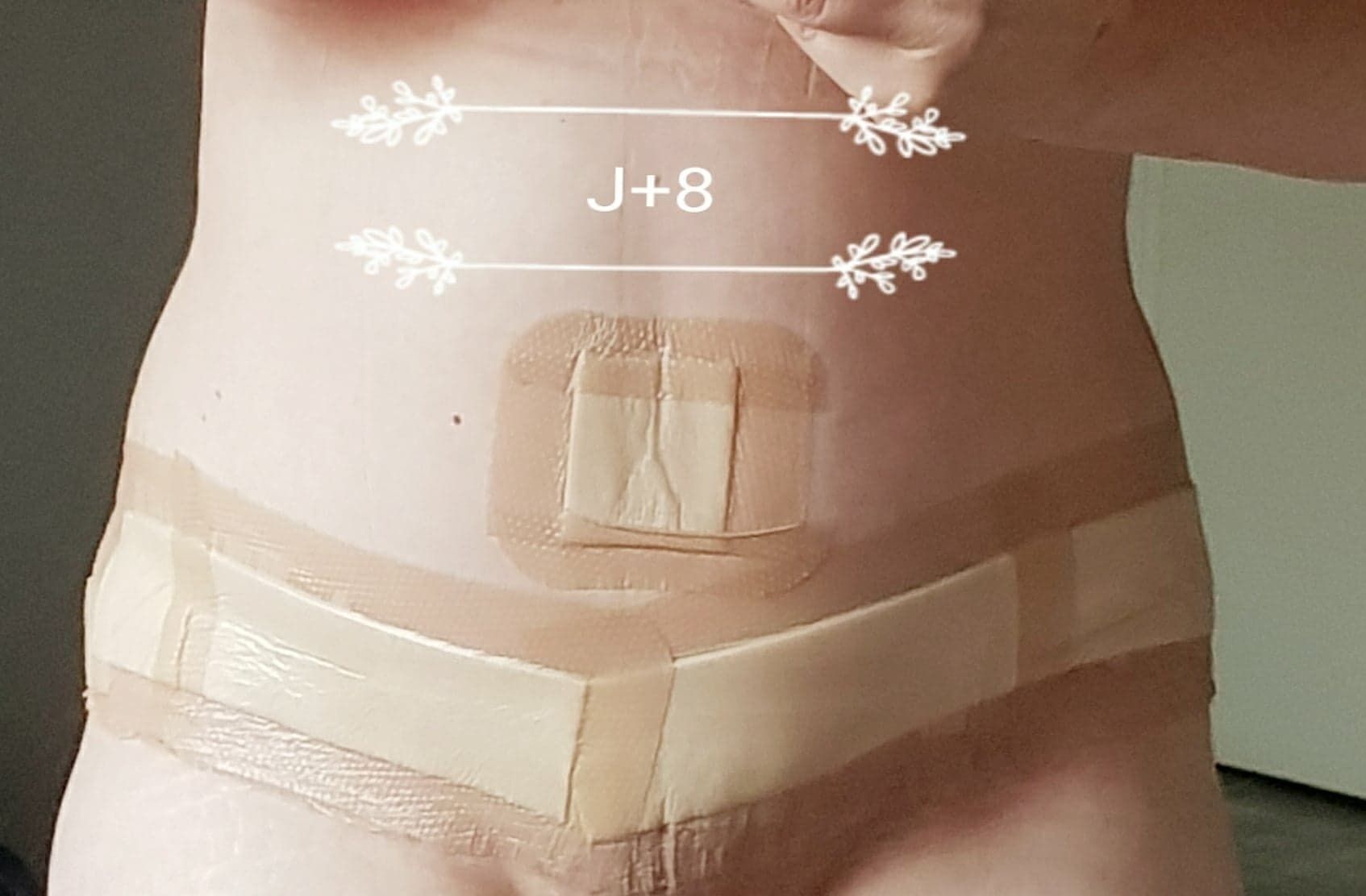 Culotte gaine post operatoire plastie abdominale avec bretelles