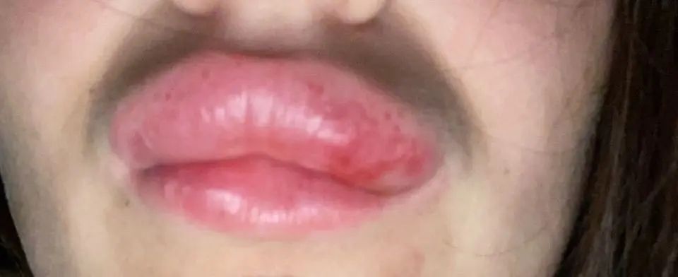 Lèvre extrêmement gonflée après injections acide hyaluronique ...