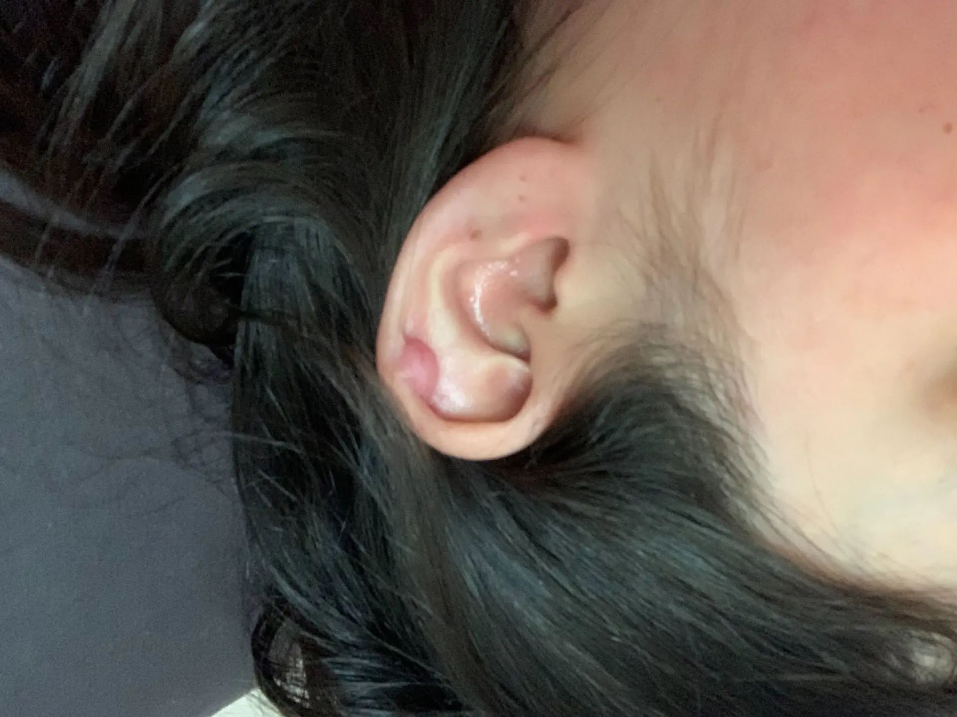 Boule à l'oreille/chéloïde - Chirurgie esthétique des oreilles ...