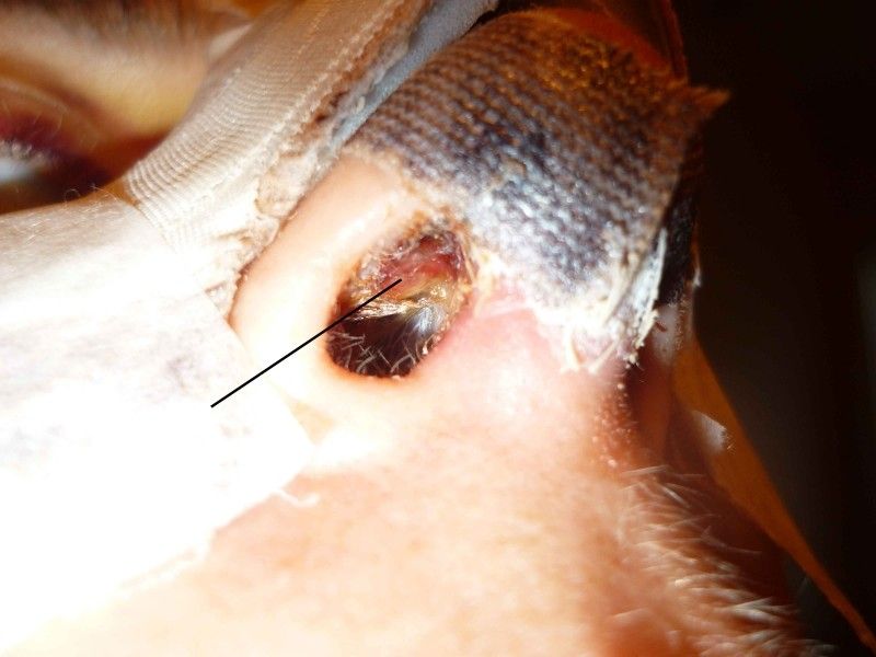Apparition d'une boule dans la narine après une rhinoplastie ...