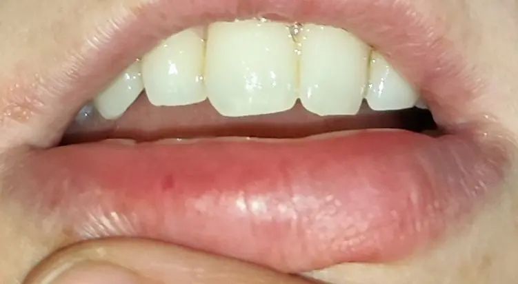 Tâche rouge sur la lèvre inférieure - Augmentation des lèvres ...