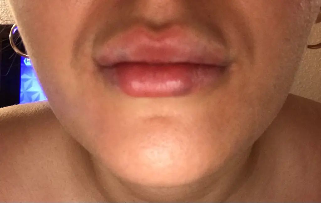 Gonflement asymétrique lèvres - Augmentation des lèvres ...