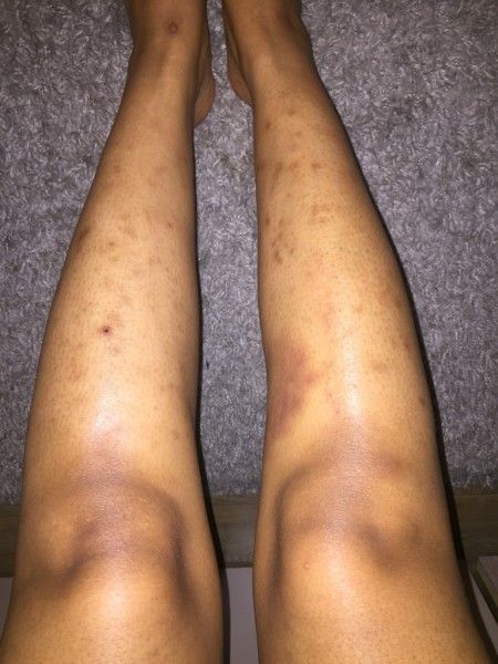 Traitement des cicatrices sur les jambes - Traitement des ...