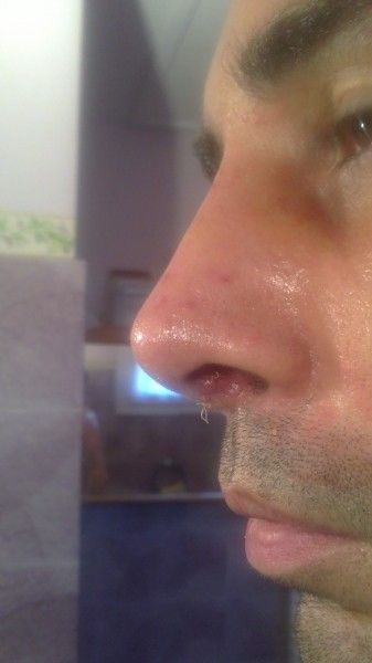 Gonflement apres une rhino - Rhinoplastie (chirurgie du nez ...