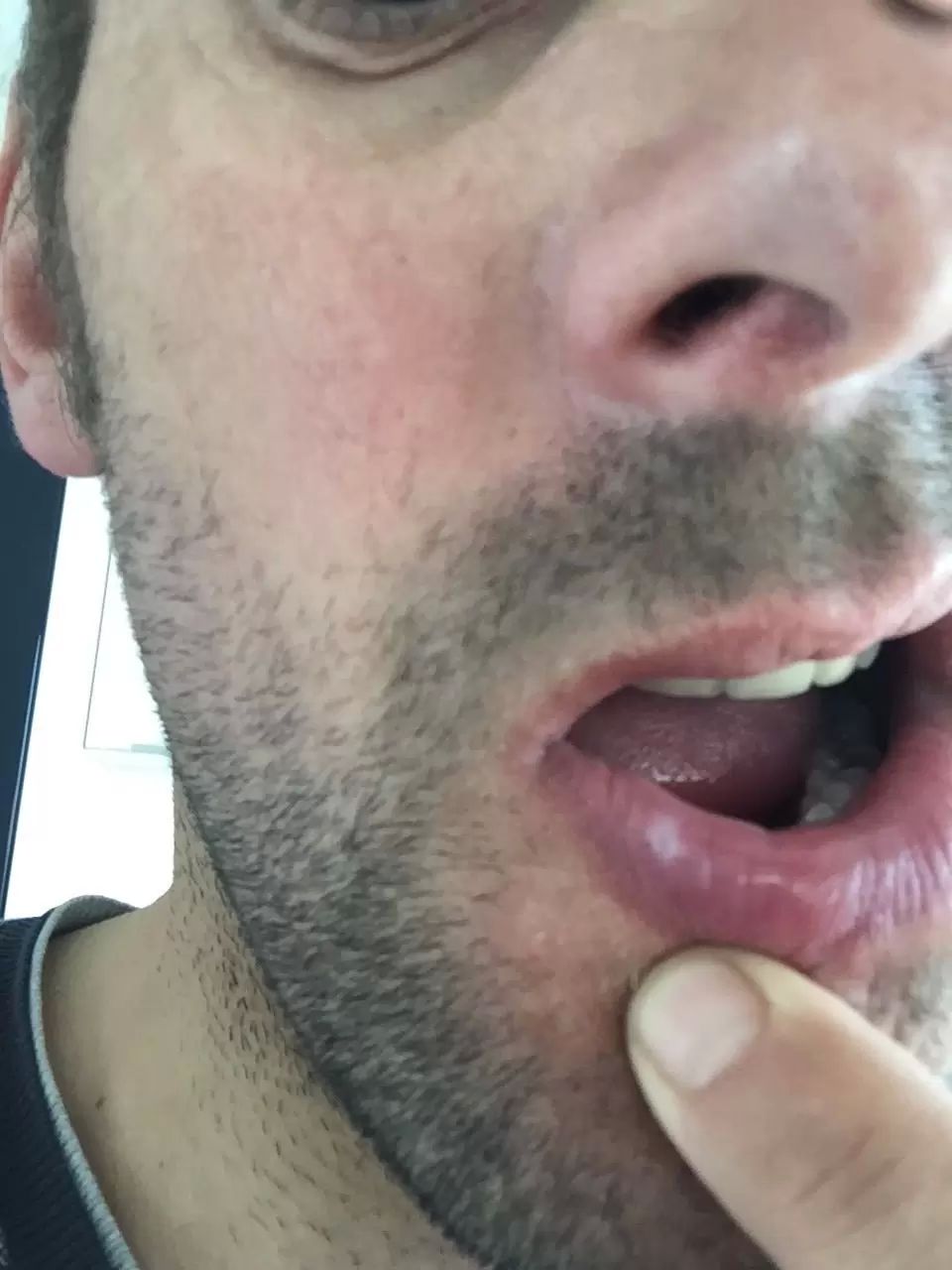 Boule lèvre suite à une cicatrice - Augmentation des lèvres ...