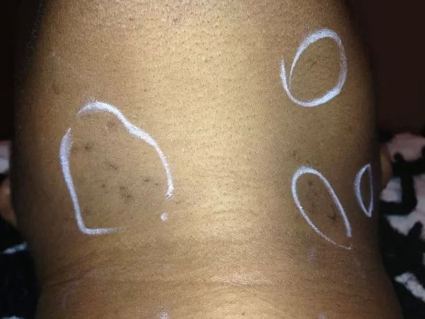 Epilation laser cou seance n°11