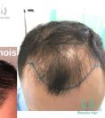 Greffe de cheveux - Cliché avant - Phoenix Hair Center