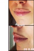 Augmentation des lèvres - Cliché avant - Dr Hai Seroussi