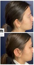 Otoplastie (Chirurgie esthétique des oreilles) - Cliché avant - Dr Romain Viard