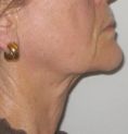 Chirurgie du double-menton - Cliché avant - RS Esthétique - Centre d’amincissement & remodelage de la silhouette anti-âge visage et corps sans chirurgie