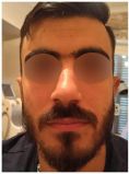 Otoplastie (Chirurgie esthétique des oreilles) - Cliché avant - Docteur Hayet Zitoun Esthétique
