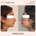 Rhinoplastie - Cliché avant - Dr Sirine Tritar