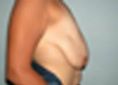 Lifting mammaire (Mastopexie) - Cliché avant - Dr Christian Berwald