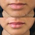 Augmentation des lèvres (acide hyaluronique) - Cliché avant - Dr Fabien Giausseran