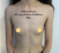 Augmentation mammaire (Implants mammaires) - Voie periareolaire
Prothèses sous le muscle pectoral