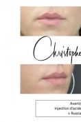 Augmentation des lèvres (acide hyaluronique) - Cliché avant