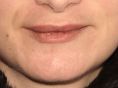 Augmentation des lèvres - Cliché avant - Dr Nicolas Zwillinger
