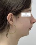 Dr Frédéric Barere - A partir de quel âge opérer les jeunes patients en chirurgie Maxillo-faciale ?
-Pour la génioplastie : environ 12 ans
-Pour la chirurgie des mâchoires en arrière : environ 14 / 15 ans
-Pour la chirurgie des mâchoires en avant : environ 17 / 18 ans (fin de croissance)
-Pour la Rhinoplastie environ 17 / 18 ans (maturité psychologique …)
Ici, patiente opérée d’une ostéotomie avancée de la mandibule. Résultat à 8 mois.