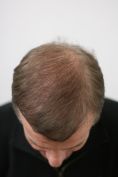 Traitements de la chute des cheveux - résultat à 6 mois, FUT, une grande séance de 5000 cheveux