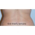 Dr Thierry Lemaire - Photos avant et un an après lipoaspiration des hanches et du dos.
La transition entre le thorax et les hanches est mise en évidence avec une ligne
courbe au niveau de la taille