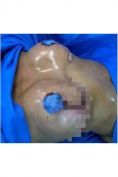 Lifting des seins avec implants - Cliché avant - Dr  Noureddine Gharib