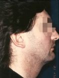 Liposuccion - Cliché avant - Dott. Andrea La Padula M.D.