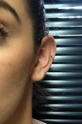Otoplastie (Chirurgie esthétique des oreilles) - Cliché avant - Docteur Pierre Laur