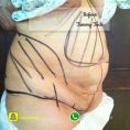 Dr. Gherissi Anas - 6 weeks post tummy tuck and liposuction.
Résultat après 6 semaines d’une abdominoplastie avec liposuccion. 
L