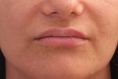 Augmentation des lèvres (acide hyaluronique) - Cliché avant - Dr Marianne AUQUE
