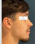 Rhinoplastie - Les décalages de classe 3 (prognathe mandibulaire / rétrognathe maxillaire) présentent souvent des asymétries faciales : déviation latérales du bas du visage, obliquité du sourire…. Il faut en tenir compte ! Résultat à 6 mois post ostéotomie Bimaxillaire