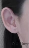 Otoplastie (Chirurgie esthétique des oreilles) - Résultat d